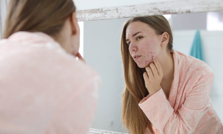 Manhattan Chemical Peels