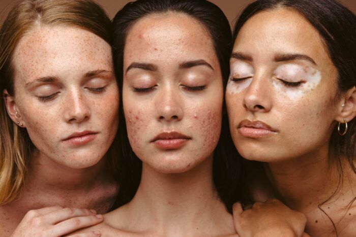 Dermaplaning NYC