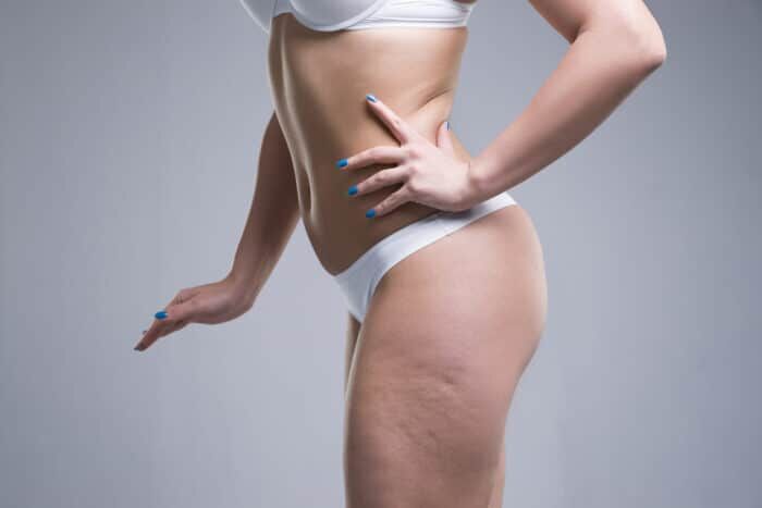 Cellulite Manhattan, New York City